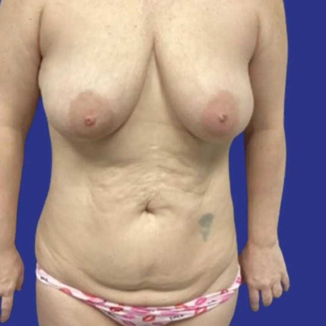 patient27before